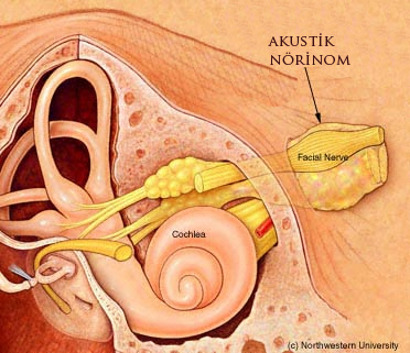 Muskuler (kaslara ait) Çınlama